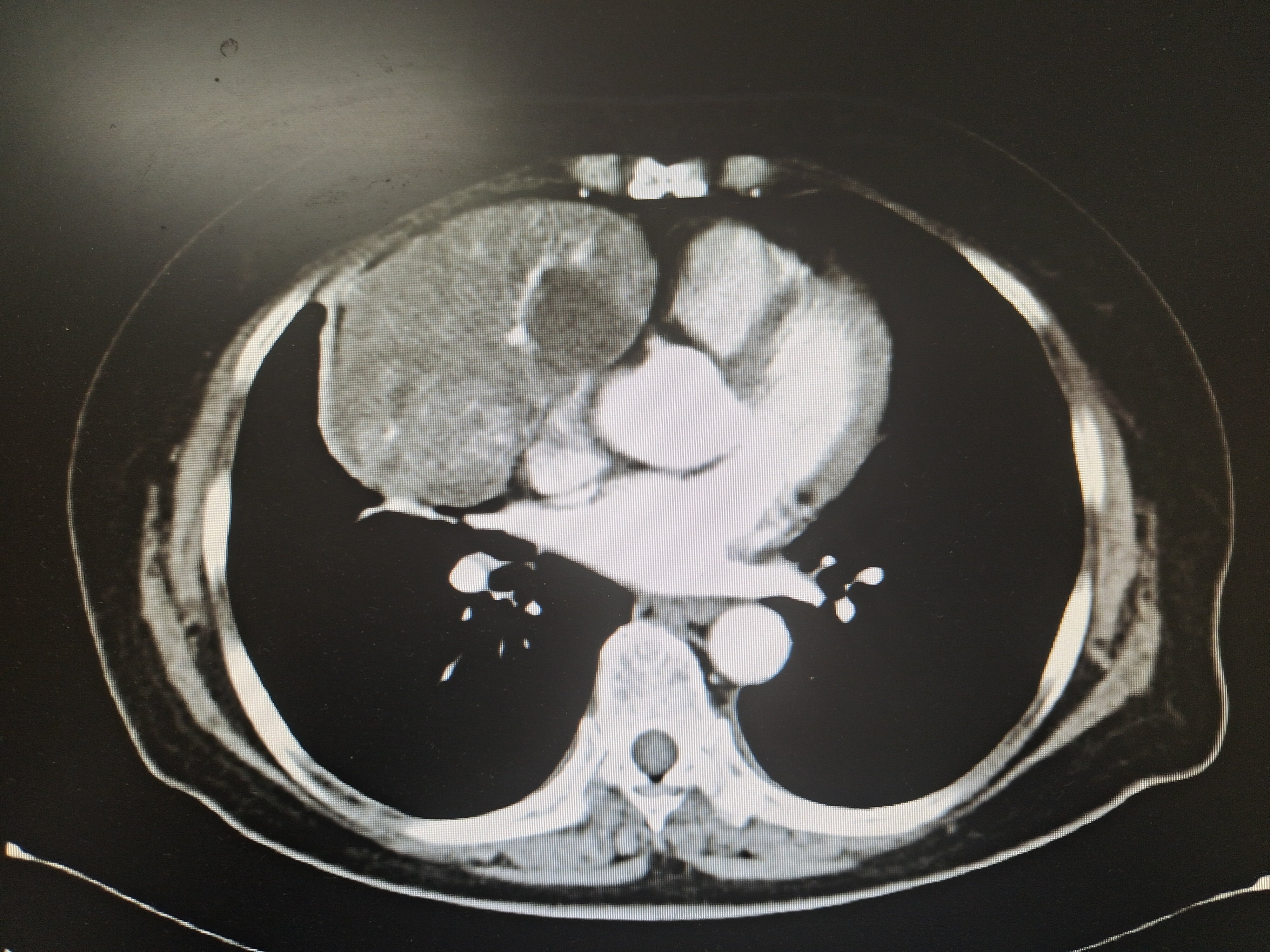 纵隔肿瘤最新研究,纵隔神经内分泌肿瘤