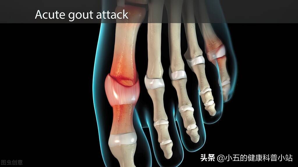 非布司他是防治痛风的常用药，可以长期服用，但需要注意这4点