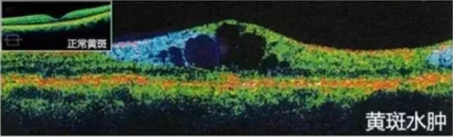 上海治疗黄斑眼病最好的医生,上海眼科黄斑变性治疗方法