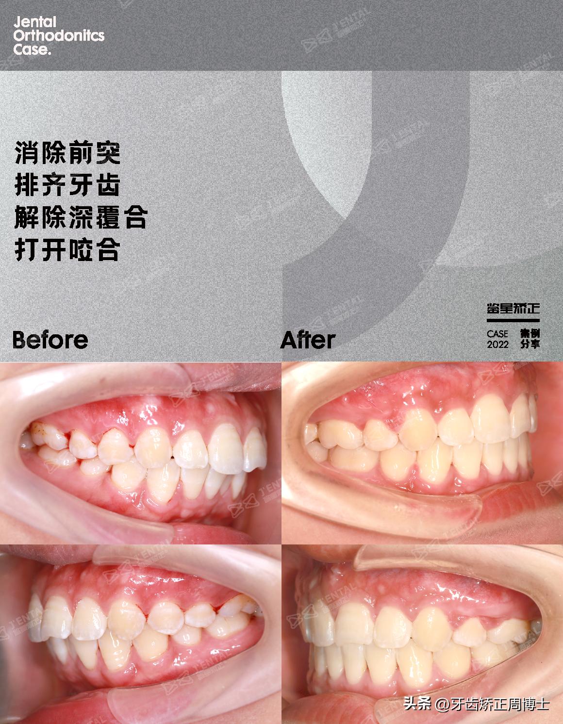 闭嘴巴下巴有核桃纹做什么手术,为什么下巴会有像核桃一样的纹路