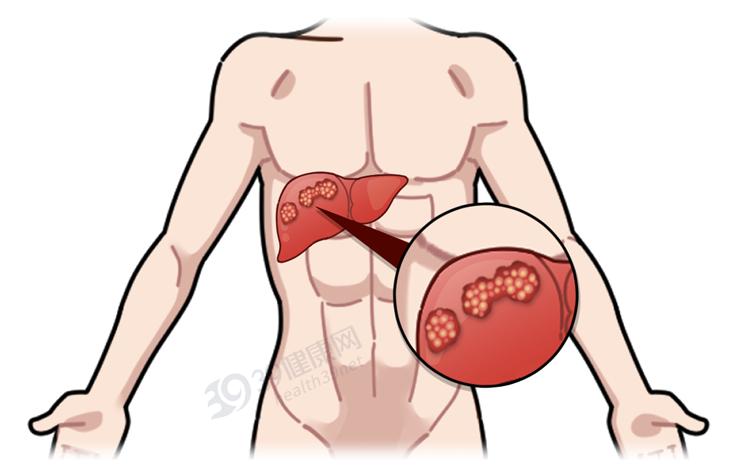 一针抗癌药可治哪几种癌,治愈恶性肿瘤癌症的真正手段
