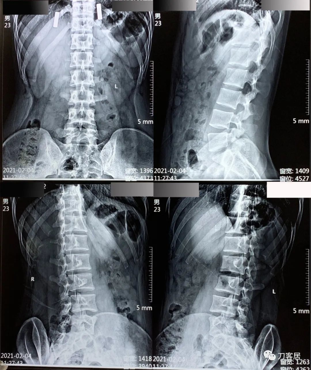 20岁出现峡部裂建议手术吗,20岁腰峡部裂了要不要手术