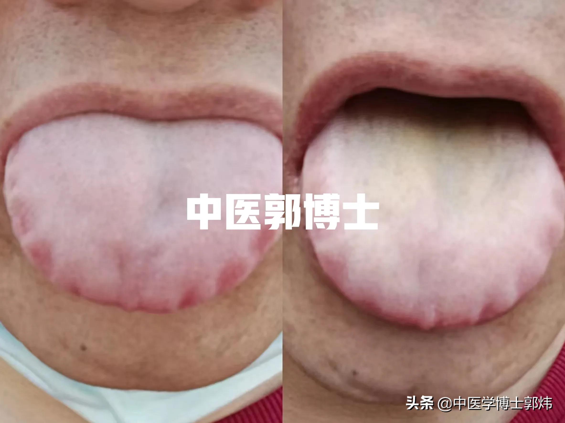 高血压怎样用天麻钩藤饮去调理,天麻钩藤饮能治疗原发性高血压吗