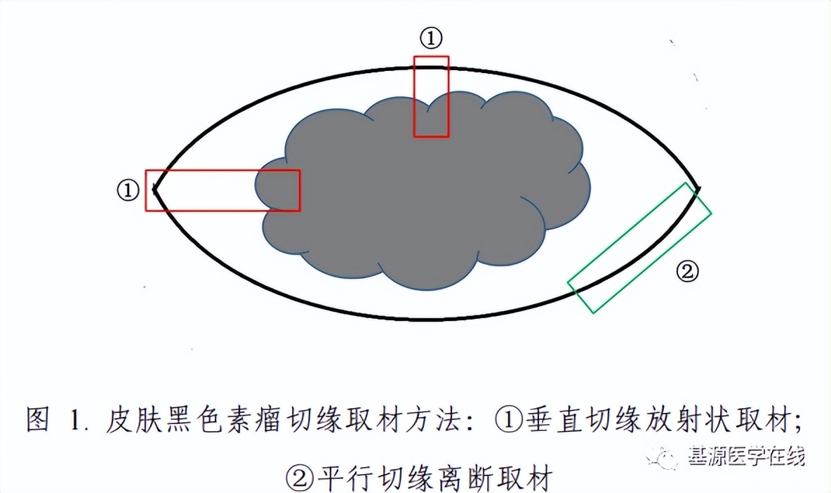 黑色素瘤诊疗指南,黑色素瘤诊疗