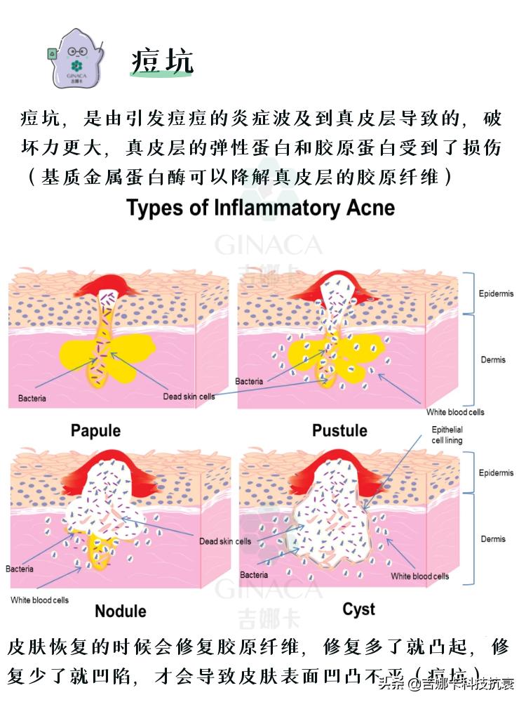 如何祛痘妙招,最简单高效祛痘方法