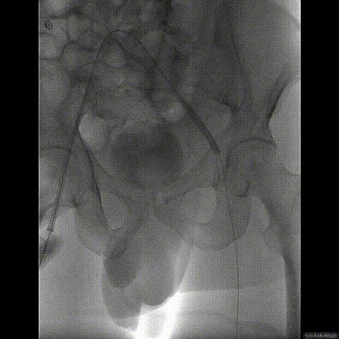 病例回顾与分享,腹膜后血肿介入治疗