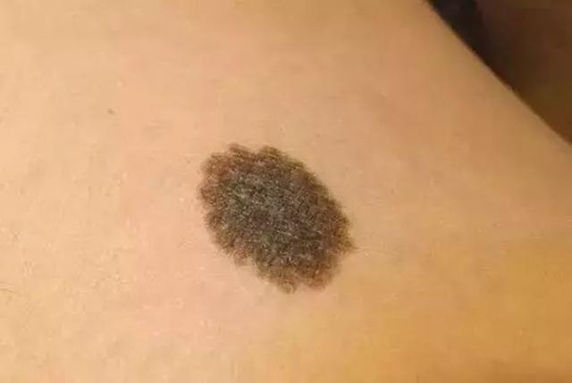 怎么在医院确定黑痣是不是良性的,黑痣隆起挂什么科检查