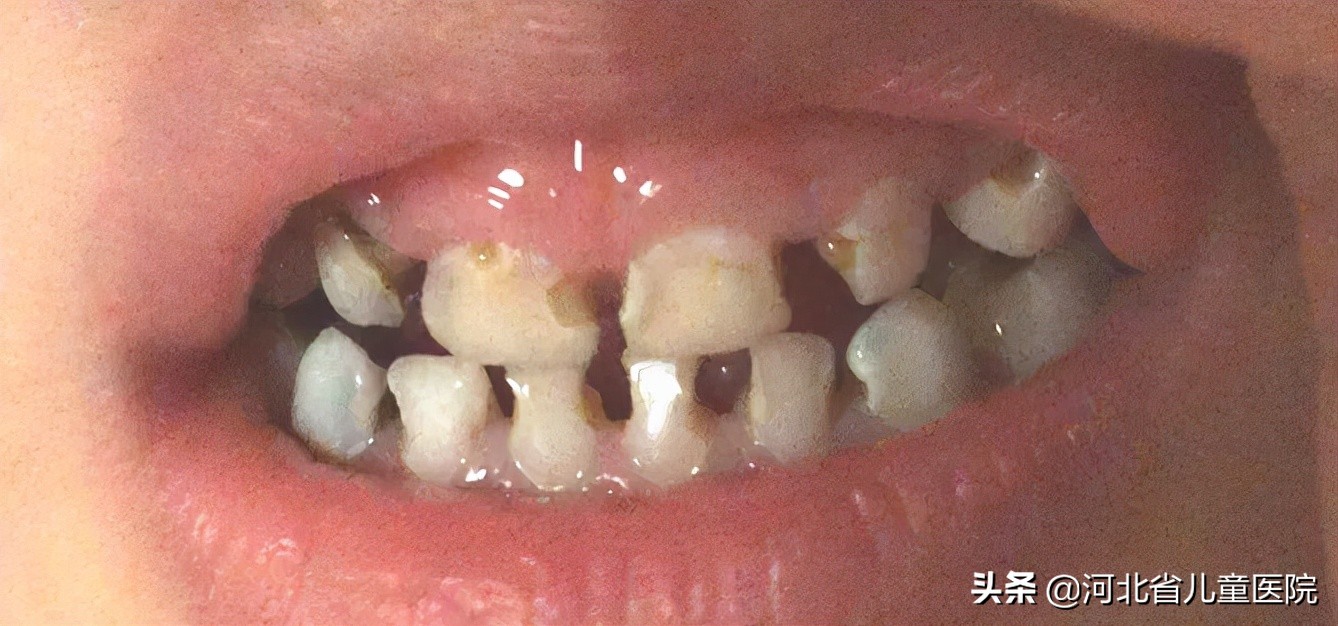 前牙龋坏修复,下前牙龋坏修复