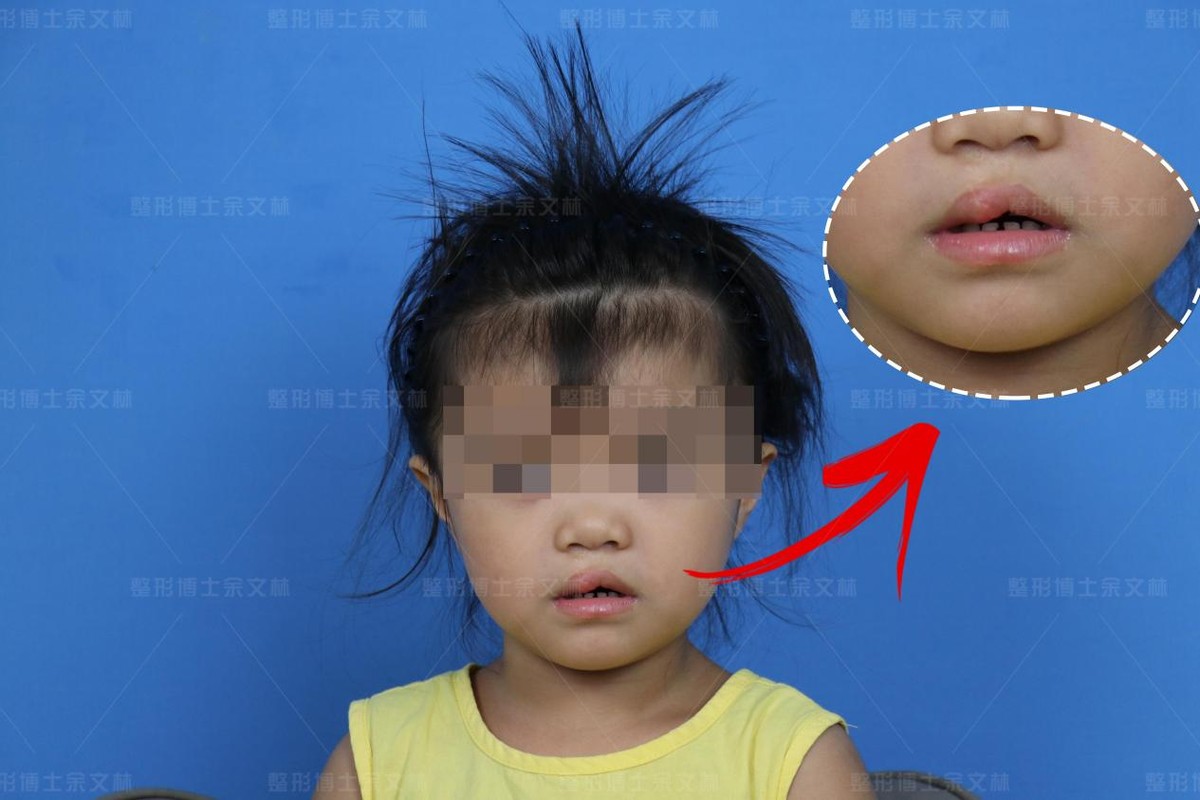 唇裂红唇修复,唇裂手术前后对比图