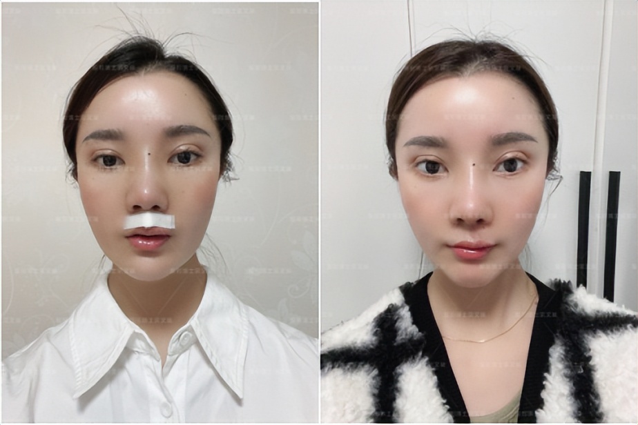 唇裂疤痕修复,唇裂修复后的疤痕怎么处理