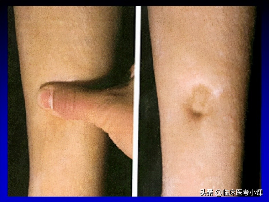 肾水肿的症状和治疗方法,诊断学水肿讲解