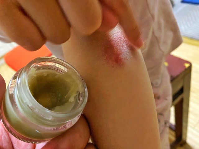 有哪些中成药治真菌肺炎,皮肤病真菌感染用什么药