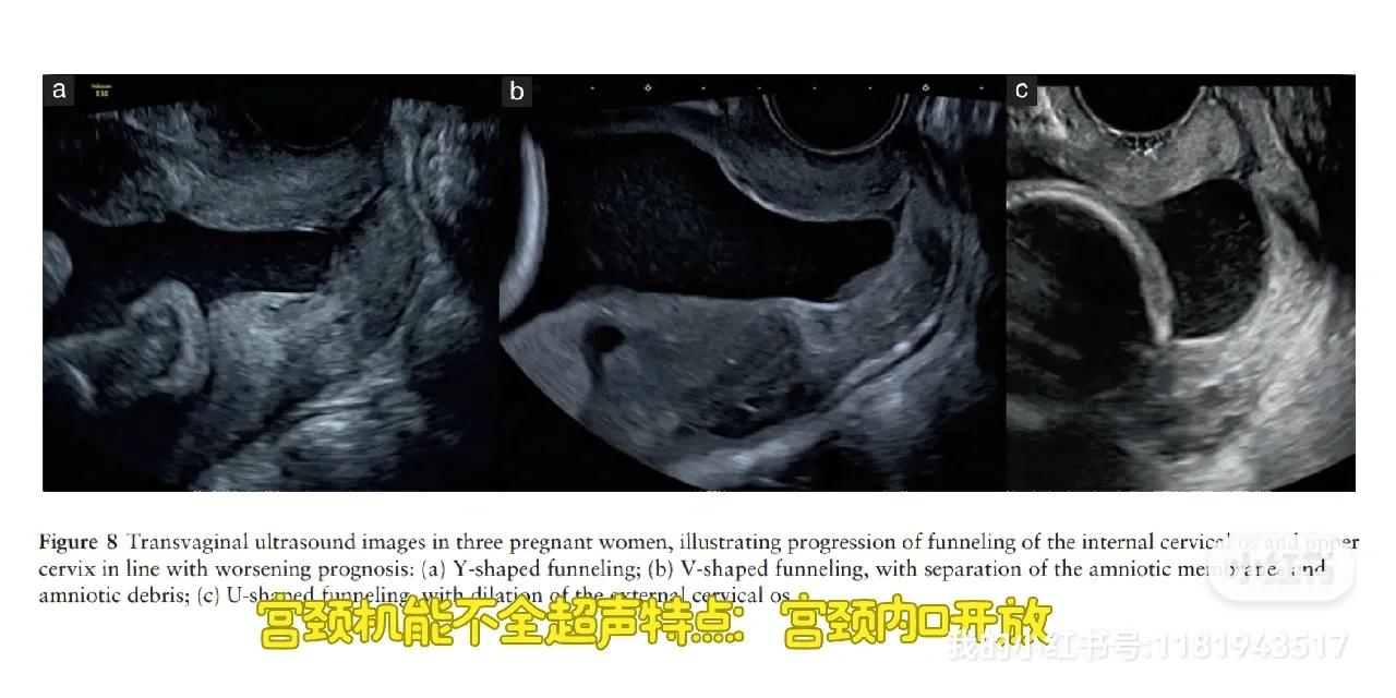 女神节特辑之什么是宫颈机能不全