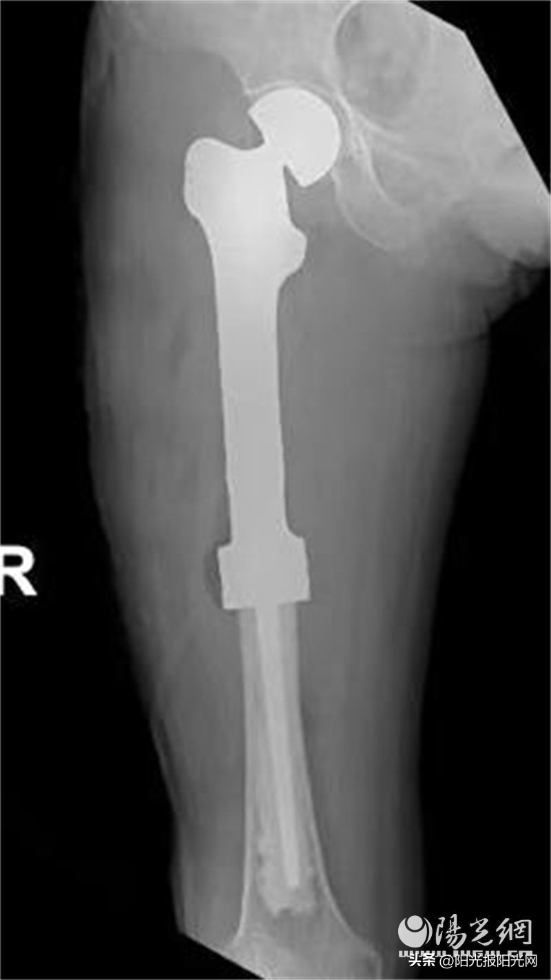 骨肉瘤3D打印假体,肿瘤型膝关节假体重建手术记录