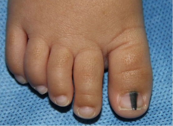 指甲竖纹与肝脏的关系,指甲盖有竖纹凸起是肝有病吗