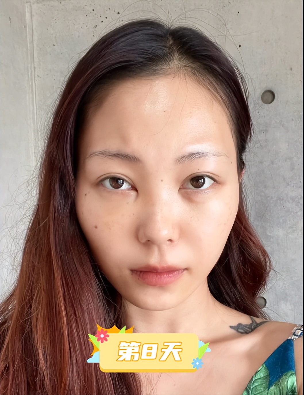 内切去眼袋手术全过程,做了去眼袋手术五天怎么还有眼袋