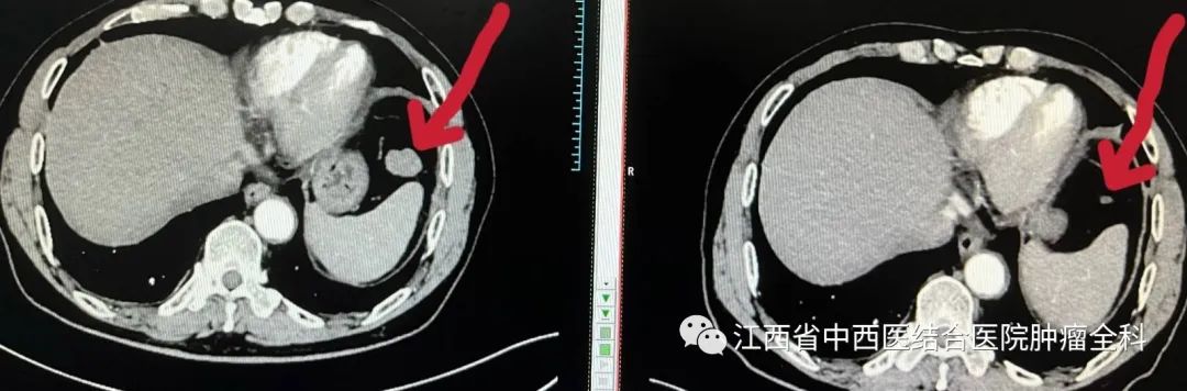 肝癌多发性肝内转移靶向药,肝癌中晚期免疫靶向有奇迹出现吗