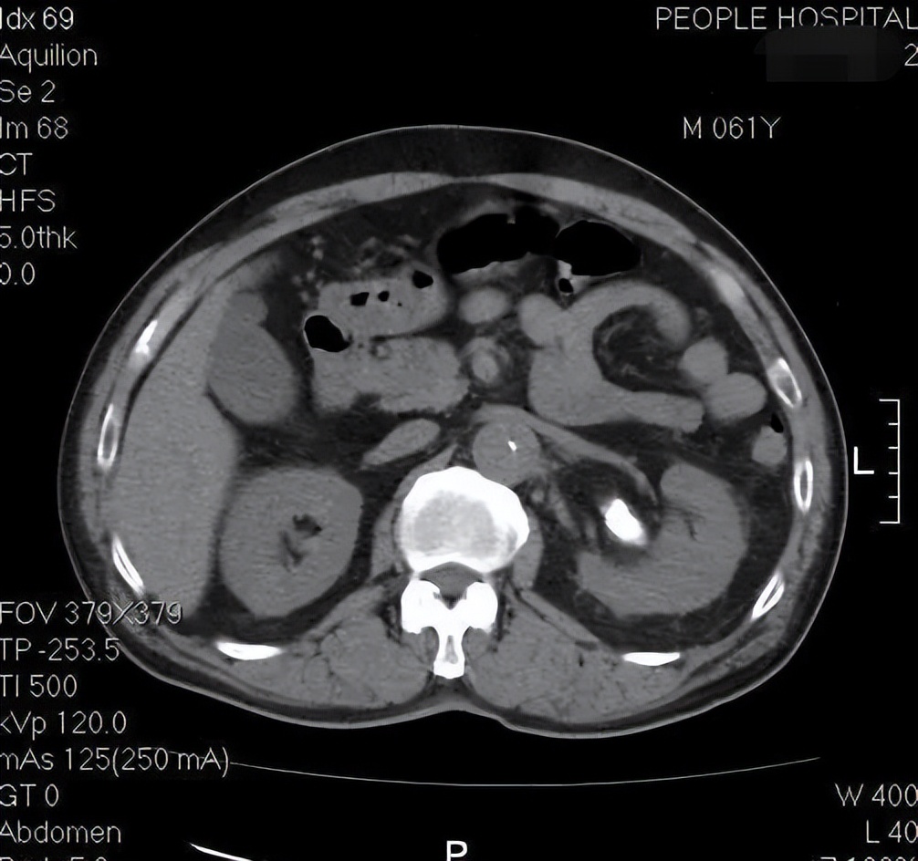 男子肾结石腰疼,男子腰部隐隐作痛一查竟是肾结石