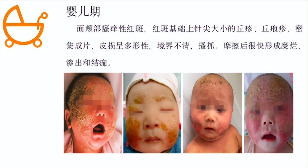 孩子得了过敏性皮炎需要忌口吗,儿科春季过敏