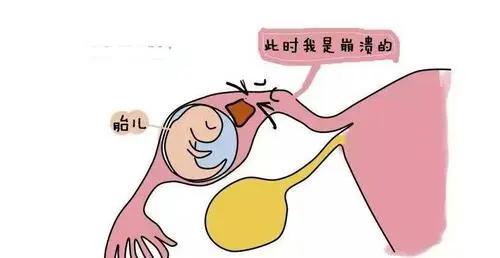 怀孕早期肚子痛就一定是宫外孕吗,怀孕早期有腹痛需要保胎么