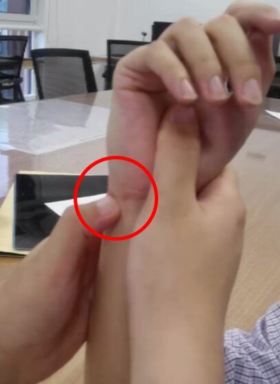 手腕三角纤维软骨复合体损伤,手腕三角软骨复合体损伤症状