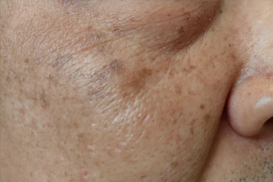 面部皮炎是炎症吗,脂溢性皮炎面部痒