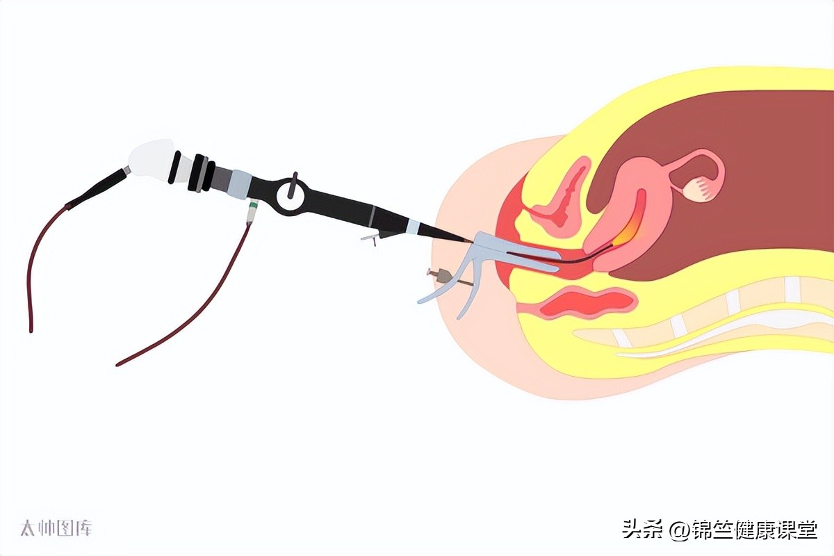滴滴答答不干净，可能是这个地方长息肉了