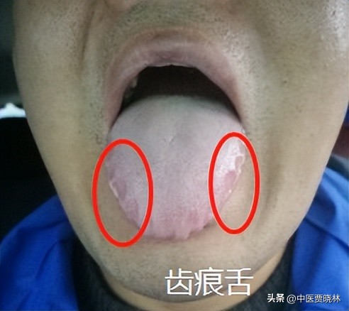 舌有齿痕属于哪一种湿气,舌边有齿痕一定是体内湿气吗