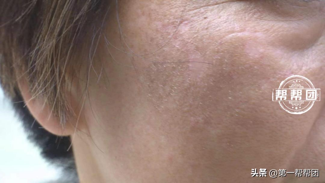 激光祛斑后留下红黑色印记怎么办,激光祛斑一个月后出现黄色斑点