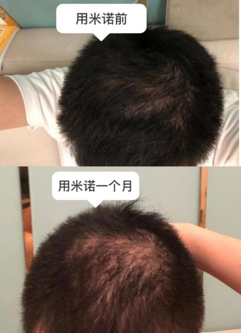 米诺地尔秃顶 (米诺地尔狂脱期会不会脱成秃子)