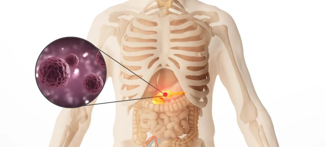 胰腺癌复发率高、预后差，联合细胞治疗提升生存期