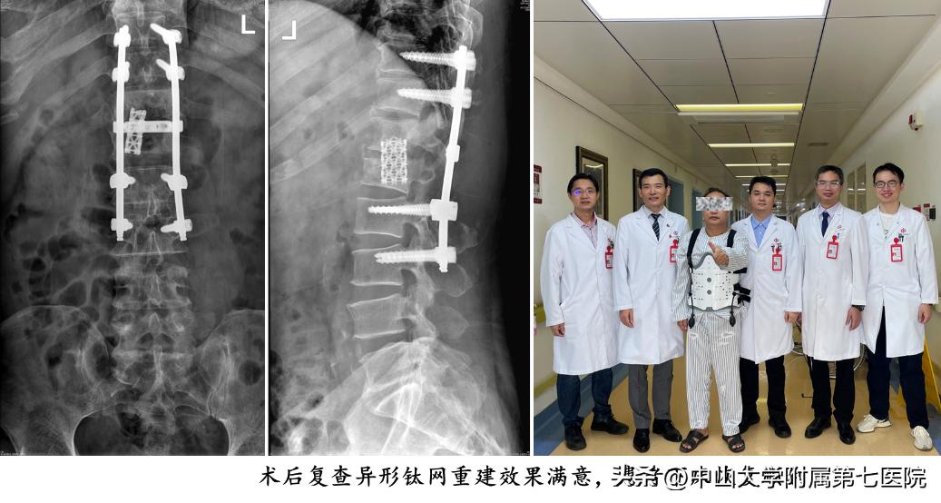 结核病菌“吃空”脊椎致腰痛难忍!人工智能辅助手术一次性解救“生命之柱”
