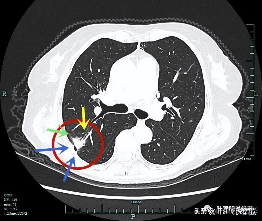 79岁肺癌早期手术风险,75岁早期浸润性肺癌还要治疗吗