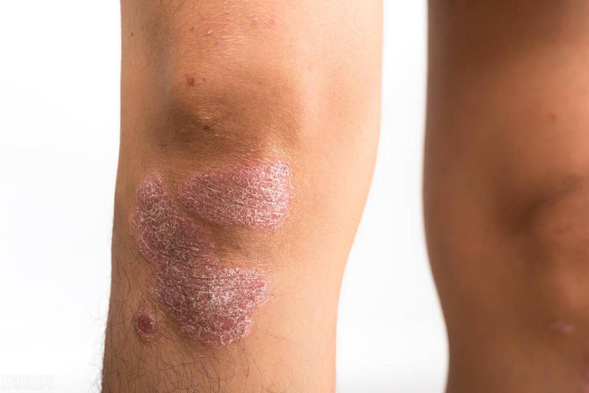 牛皮癣喝中药停用多久可以备孕,牛皮癣患者备孕吃药