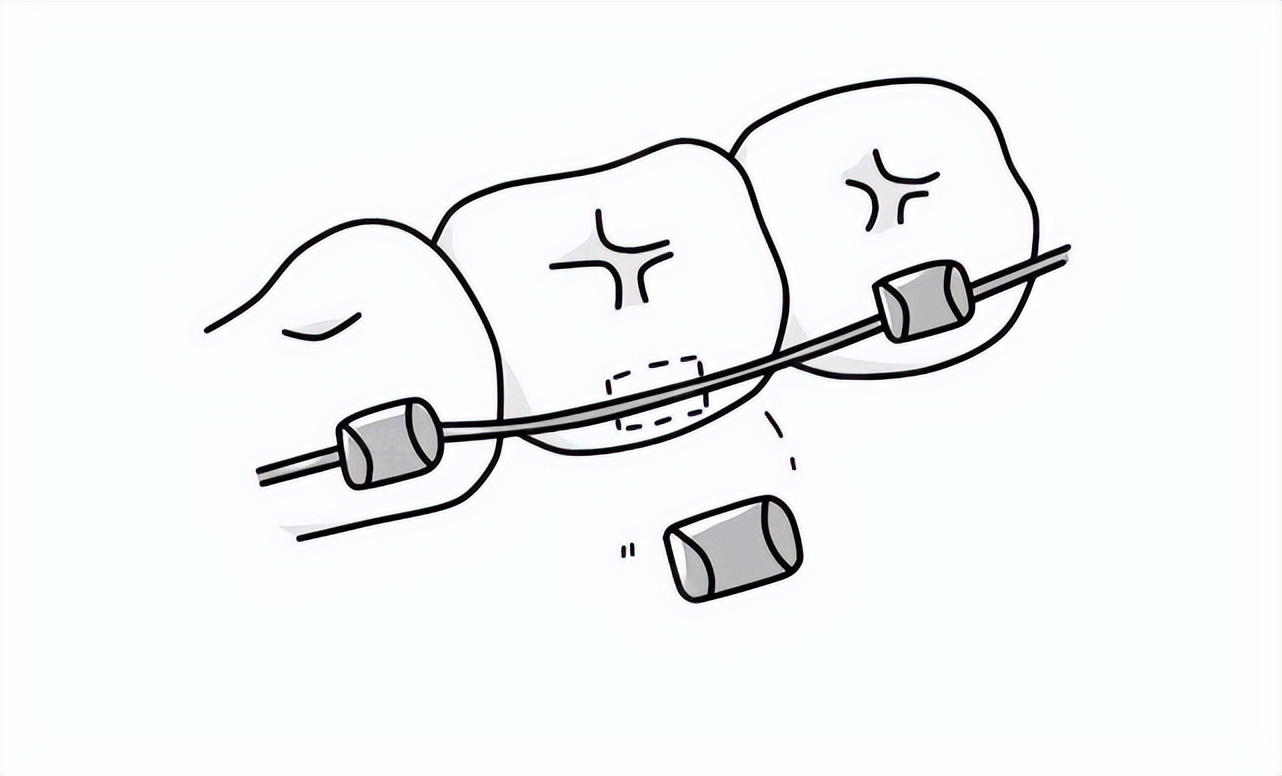 疫情期间，牙疼、牙套丢了怎么办？暨南大学穗华口腔专家在线支招