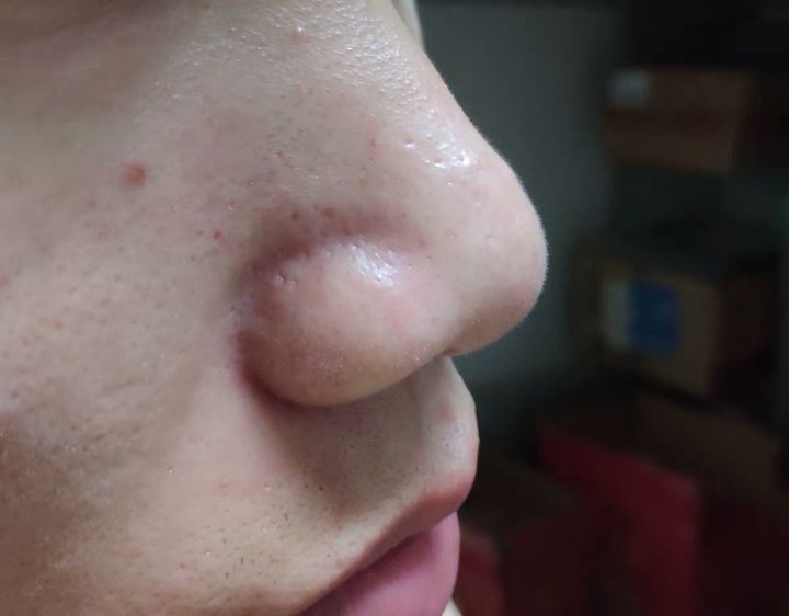 超微小气泡美容有用吗,美容院小气泡