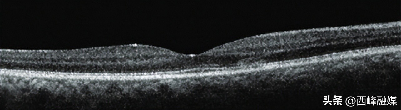 眼科发炎症状,眼睛疼是阳性的前期症状吗