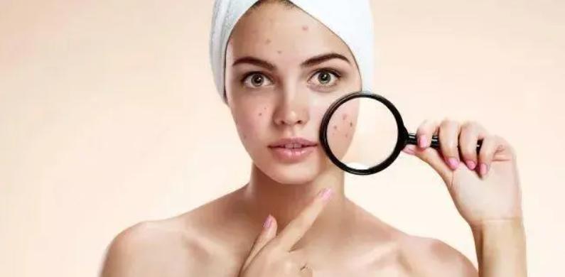 用了护肤品长痘是什么原因,有些护肤品用了会长痘什么原因