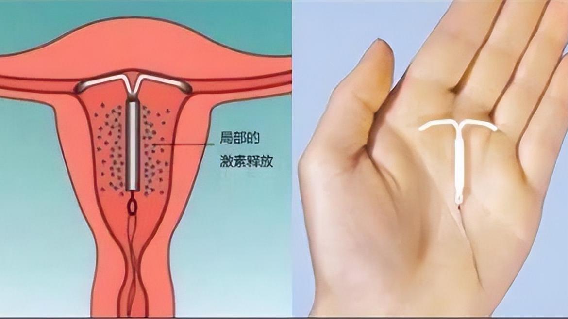 女性取出节育环后多久可以怀孕,节育环在体内有年限吗