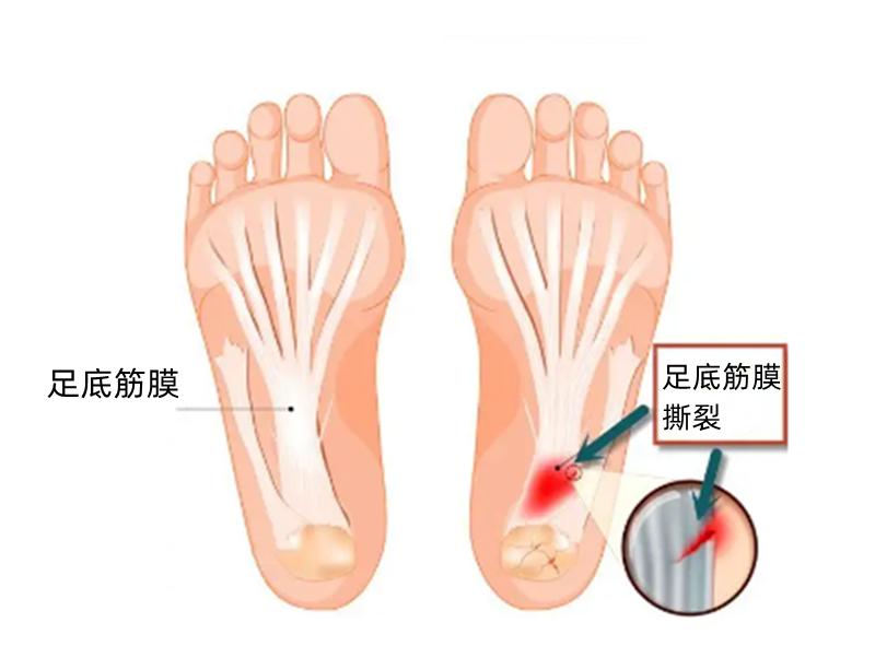 足底筋膜炎是脚底板疼吗,脚底板筋膜炎的症状及治疗