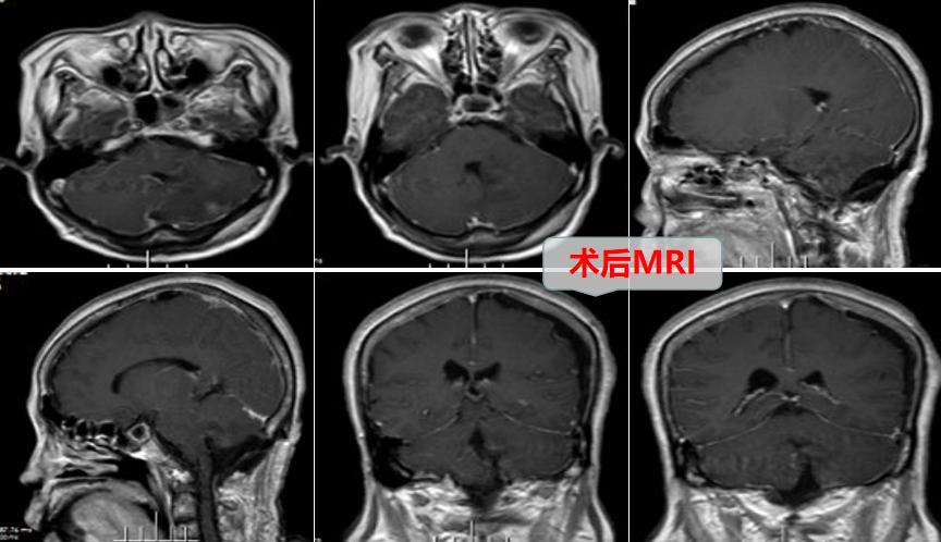 脑梗走路总想往一侧歪,走路总往右侧歪是怎么回事