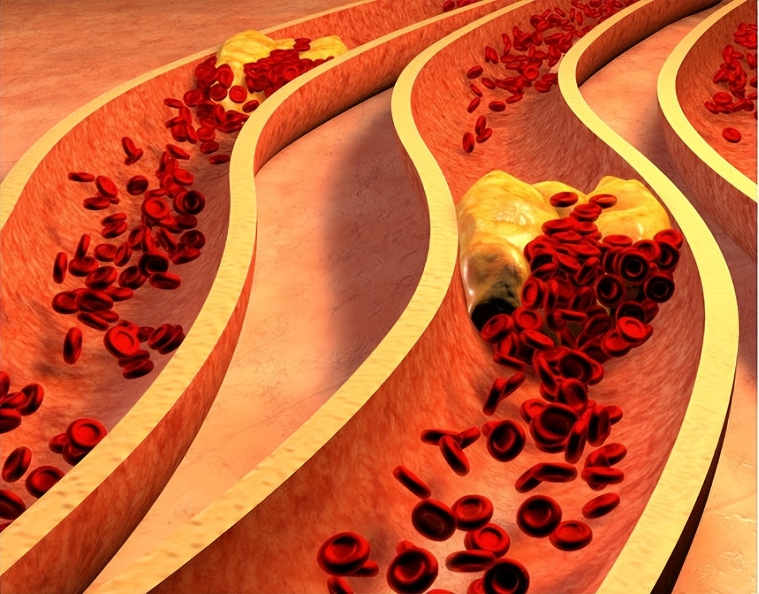 甲钴胺禁忌及注意事项,甲钴胺的六大误区您知道吗