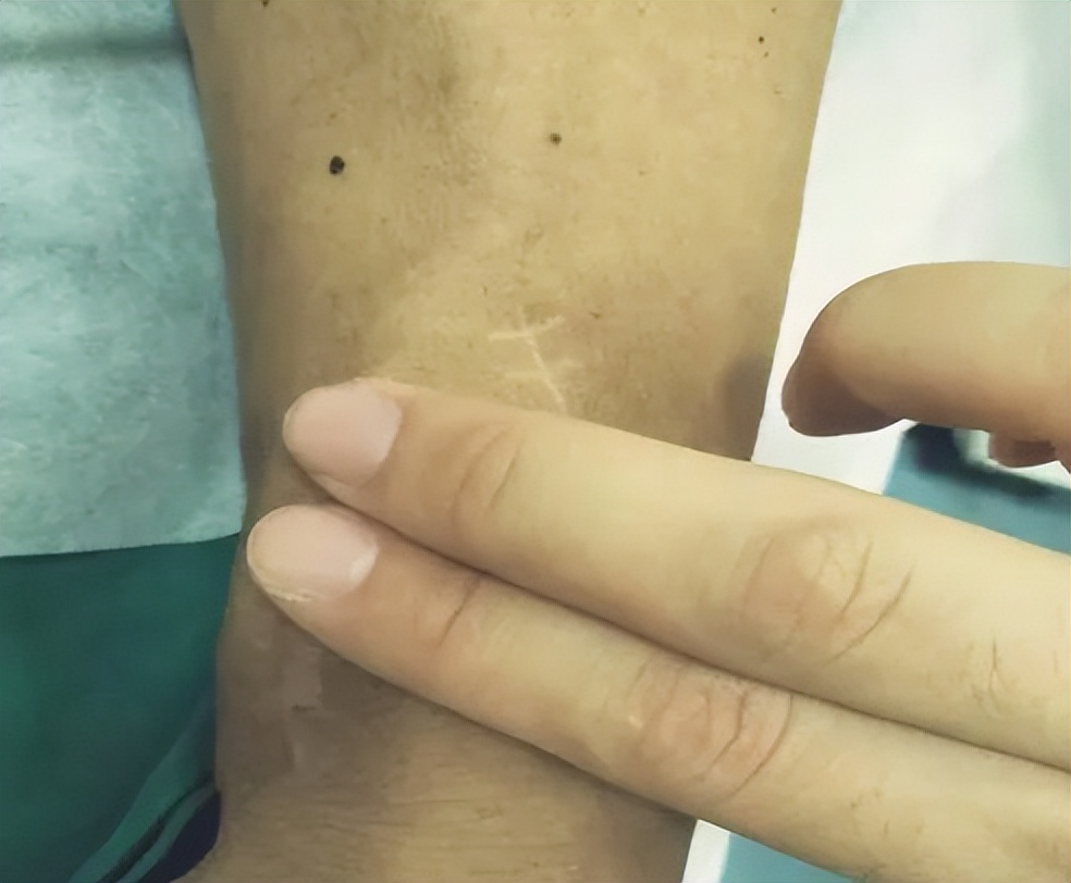 透析内瘘手术后多少天可以洗澡,透析患者的内瘘如何护理