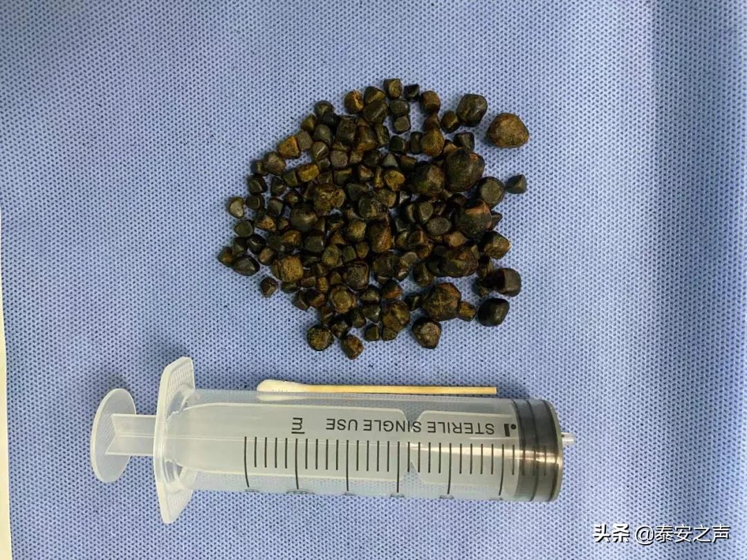 惊了！保胆取石取出164枚结石！这个团队是怎么做到的