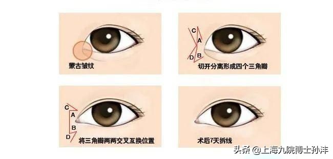一般做个眼综合双眼皮多少钱,双眼皮和眼综合的区别图片