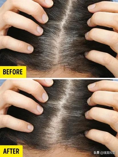 有白头发要怎么才能恢复黑发,为什么会长白头发怎么让头发变黑