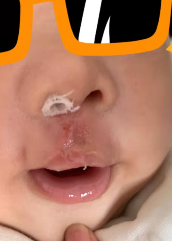 宝宝是一只“小兔子”，还没长牙就要开始正畸了