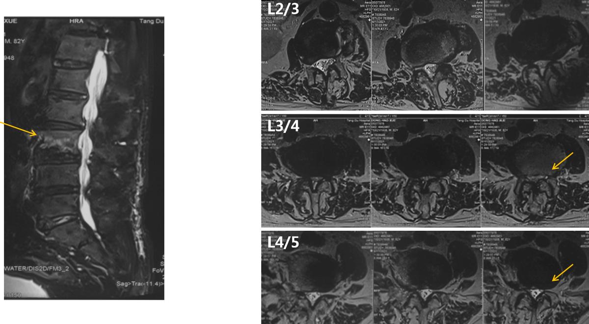 老年人脊柱侧弯的危害和症状,老人脊柱侧弯腰部疼痛怎么缓解