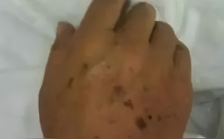 老年斑和色素沉着怎么区分,老年斑和色素沉着怎么治