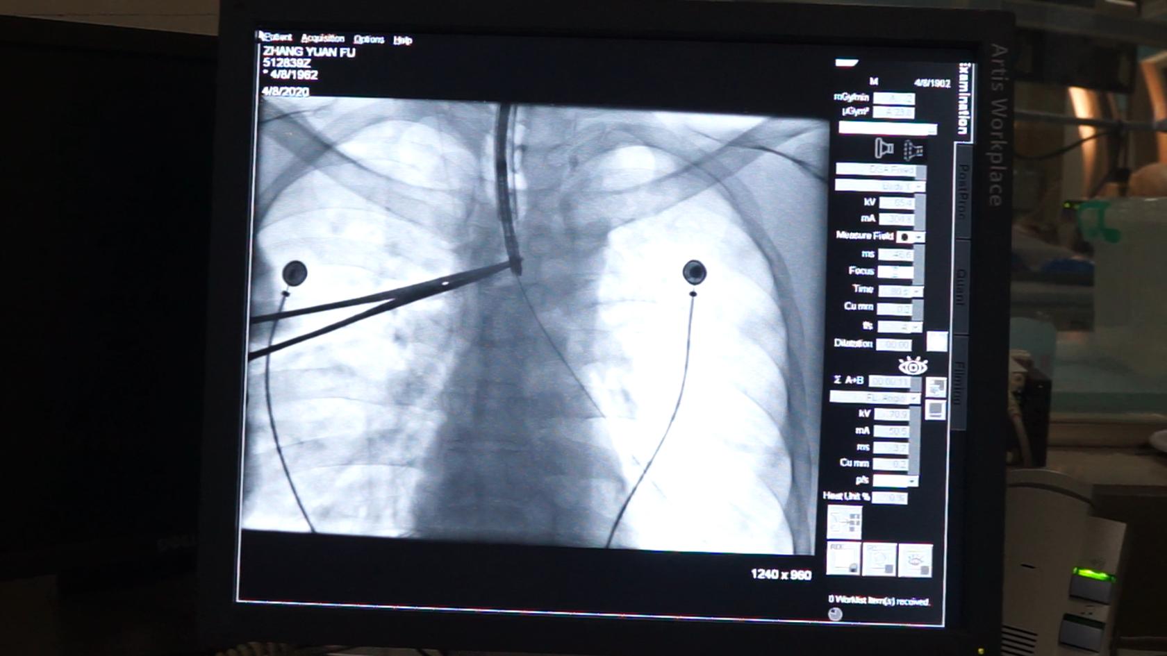 介入粒子植入和肿瘤消融术,微创可视细胞支架植入术